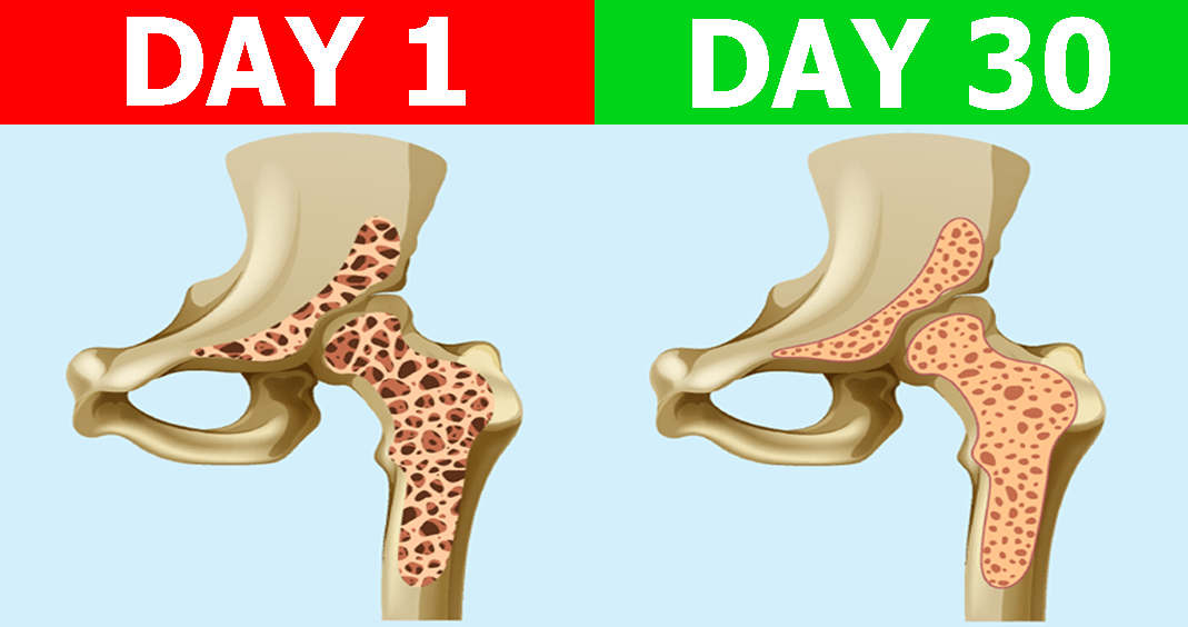 OsteoShield Day 1 - 30